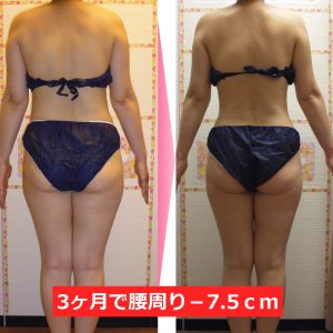 骨盤矯正ダイエット 骨盤の歪みを整え気になる脂肪にアプローチ